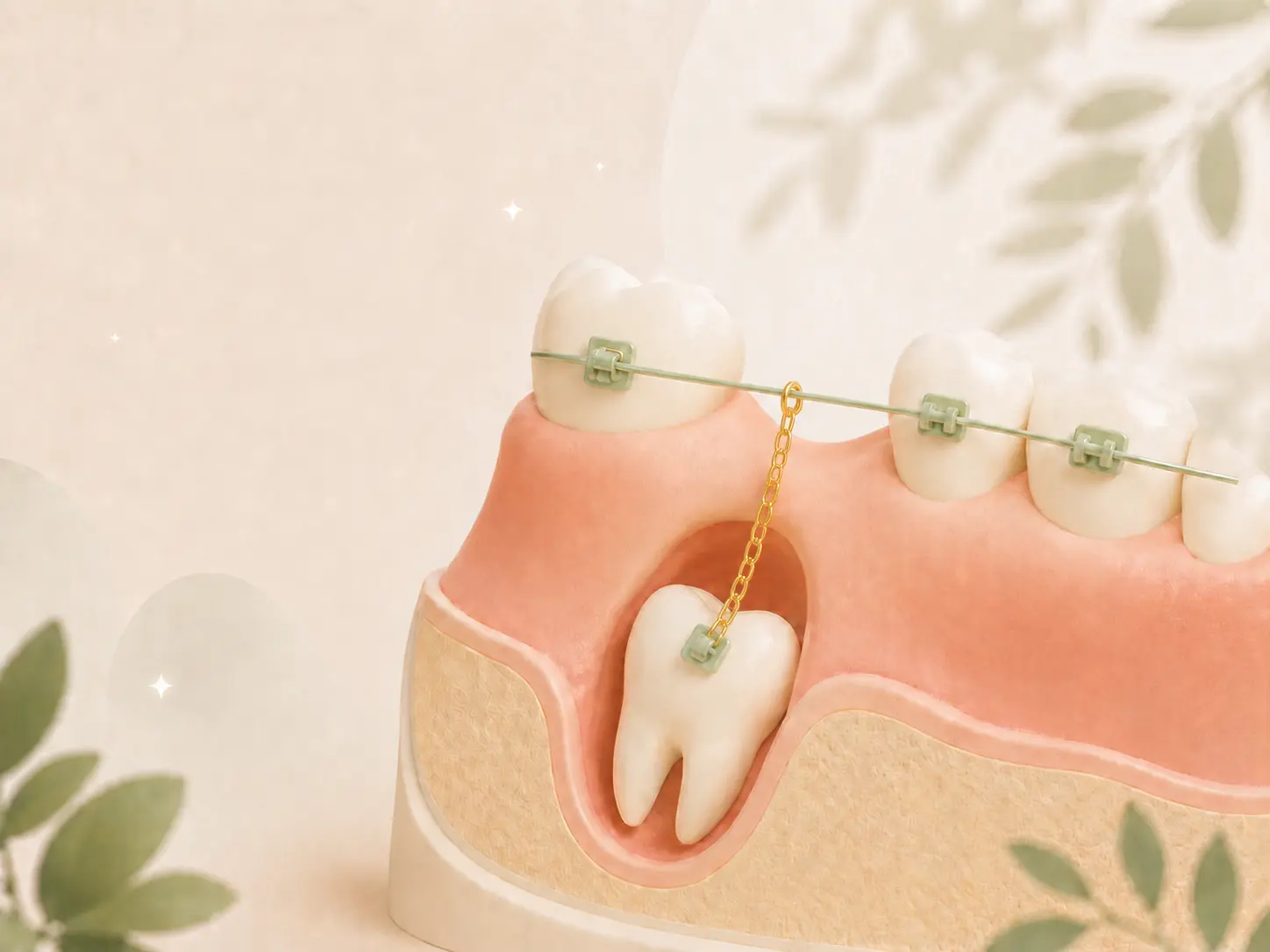 Illustration of an impacted tooth attached to orthodontic braces with a chain